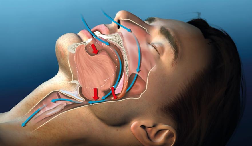 What Are the Different Types of Sleep Apnea Surgery?